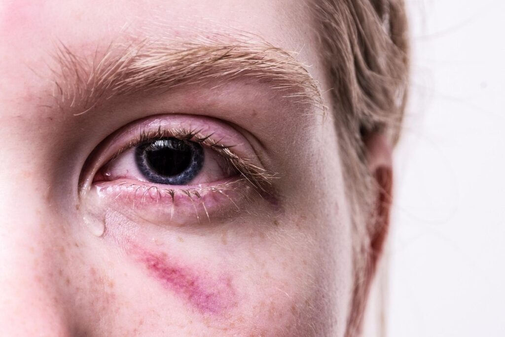 black spot iris eye for beekeepers